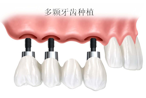 深圳种植牙多少钱一颗?