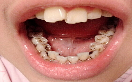 孩子牙齿上的小黑点是什么呢