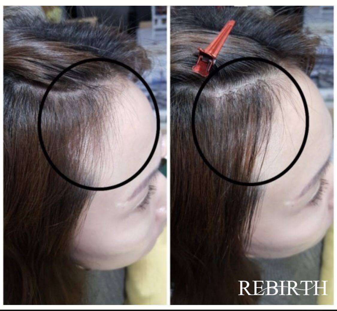 物理轻增发解决头发稀疏，发际线后移等问题