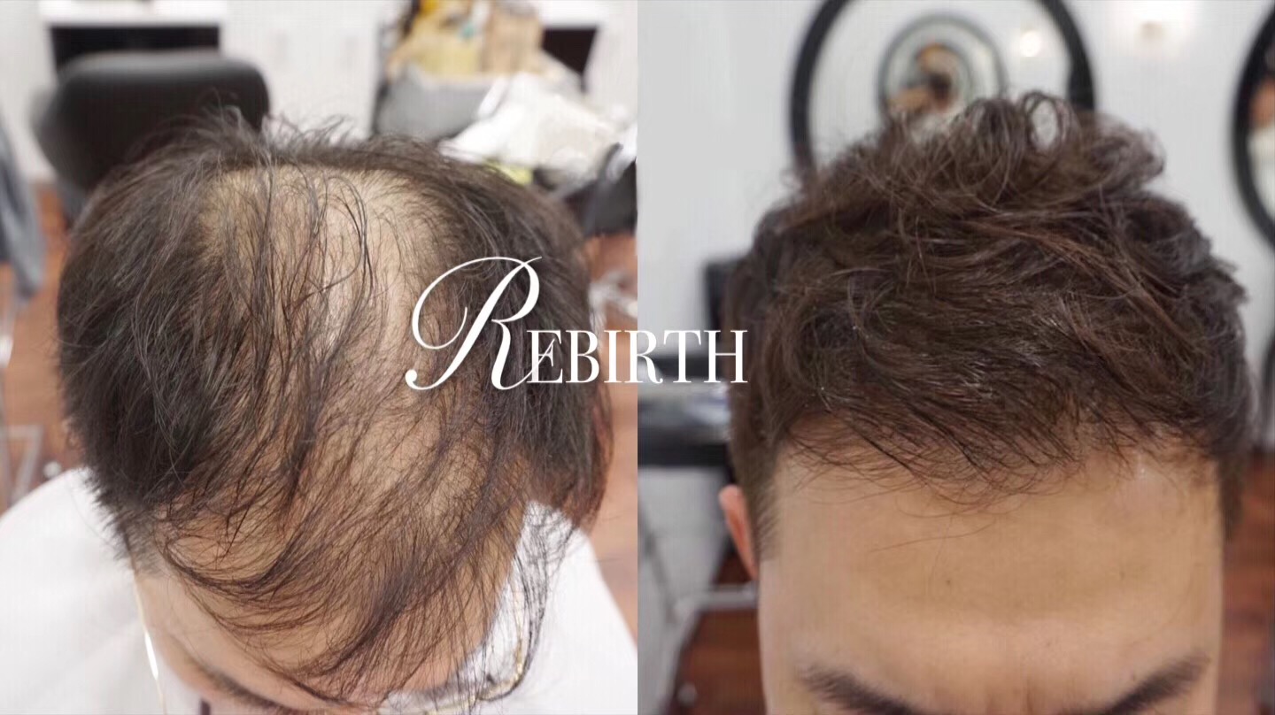 rebirth物理轻增发，头发稀疏加密，脱发增补，发际线后移增补
