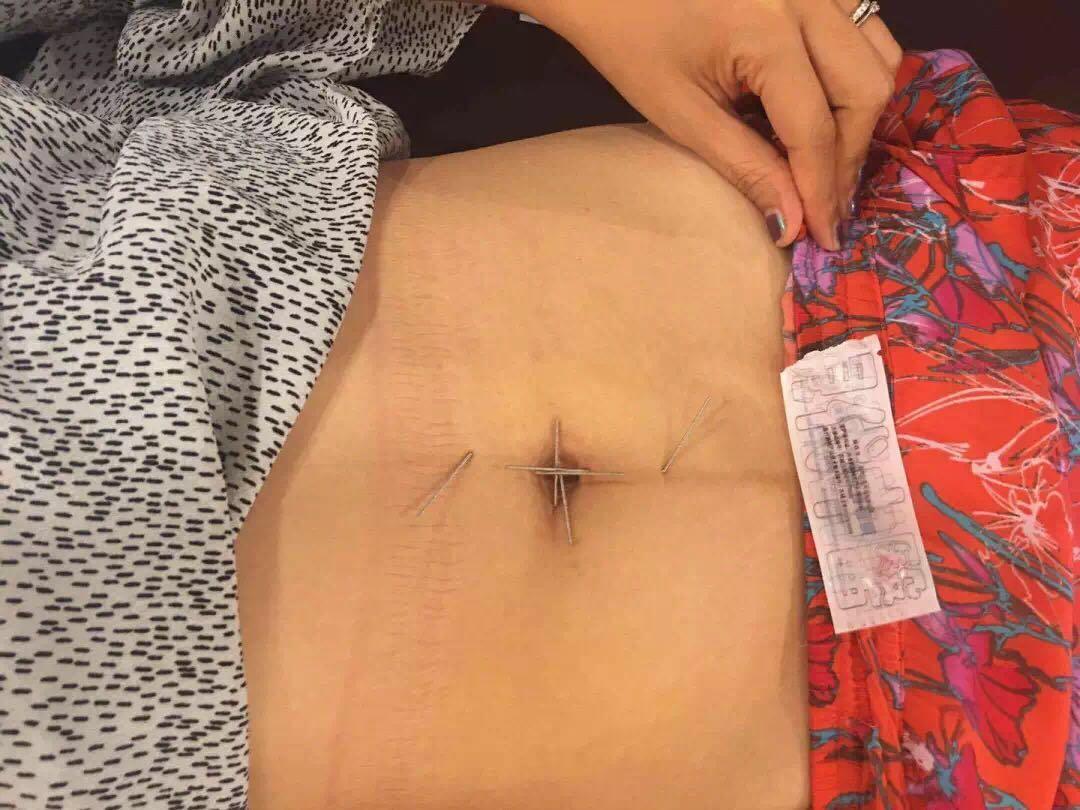 长春针灸减肥培训效果如何