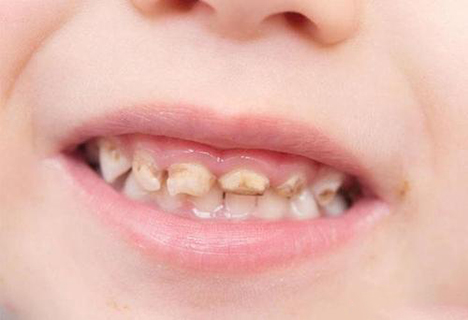 儿童龋齿治疗_儿童龋齿的危害