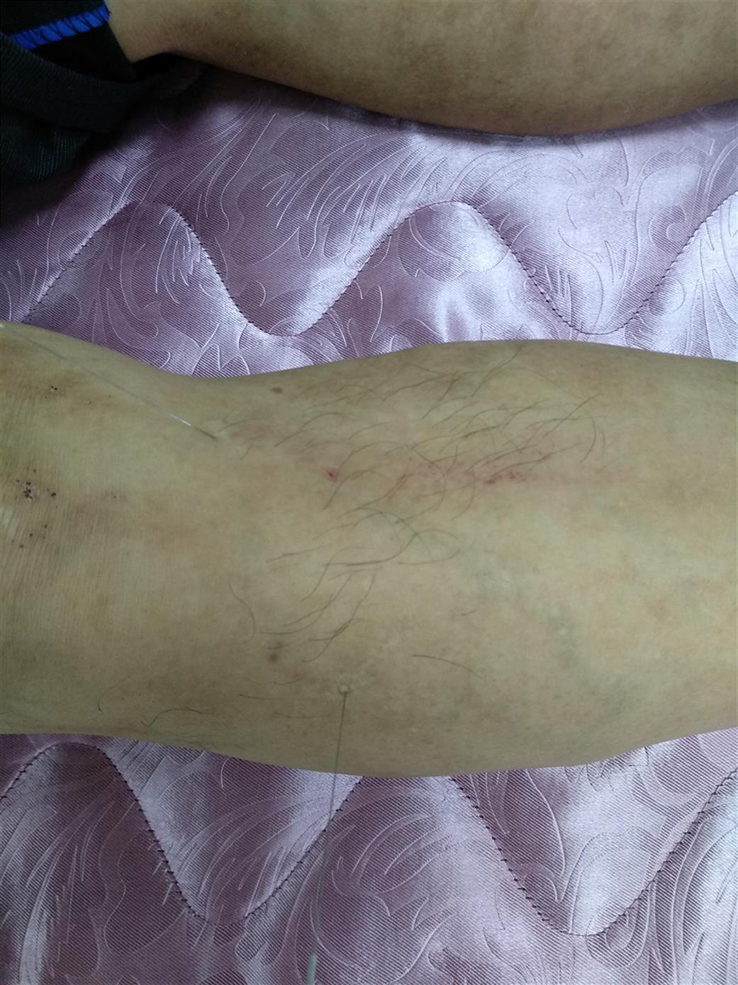 苏州类疼痛病效果如何
