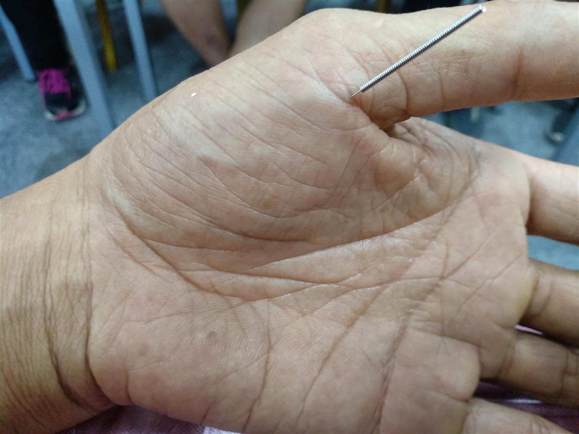 南昌类疼痛病效果如何