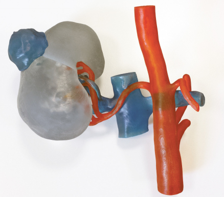 青岛3D打印肾脏模型