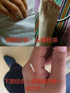 成都正规邱飞虎闪电针灸培训价格