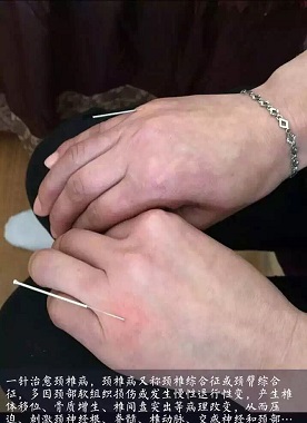 武汉热门邱飞虎闪电针灸培训