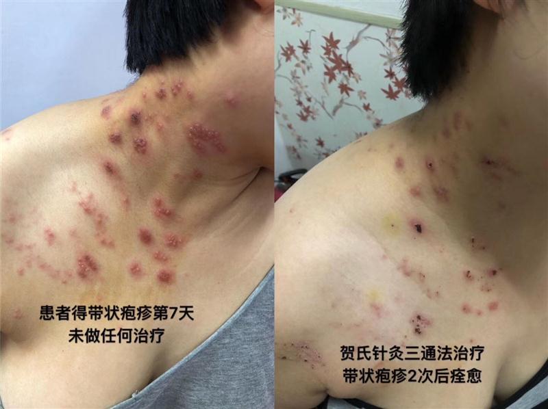 贵州省毕节市贺氏针灸三通法