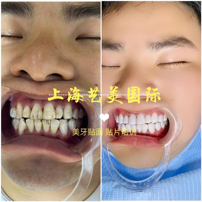 桂林美牙贴面培训课程