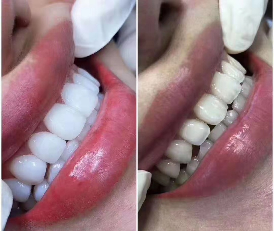 贴面美牙有哪几种？