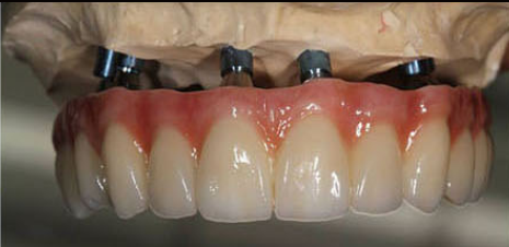 美牙牙专业生产加工义齿和种植牙的厂家 深圳义齿加工厂