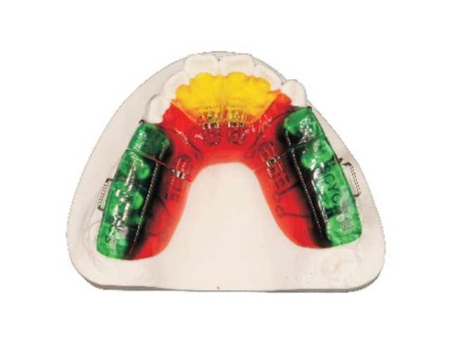 广东四眼圈簧扩弓器如何佩戴 深圳市深创义齿技术供应
